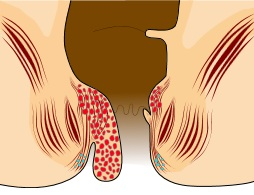 Illustration for article titled Nama Obat Benjolan Wasir Stadium 4